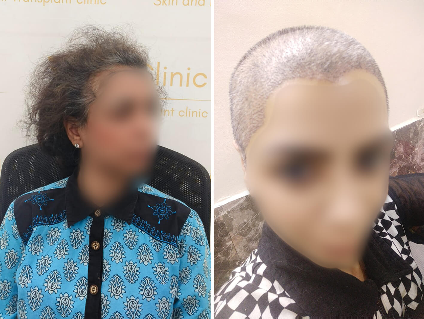 Natural female hair transplant